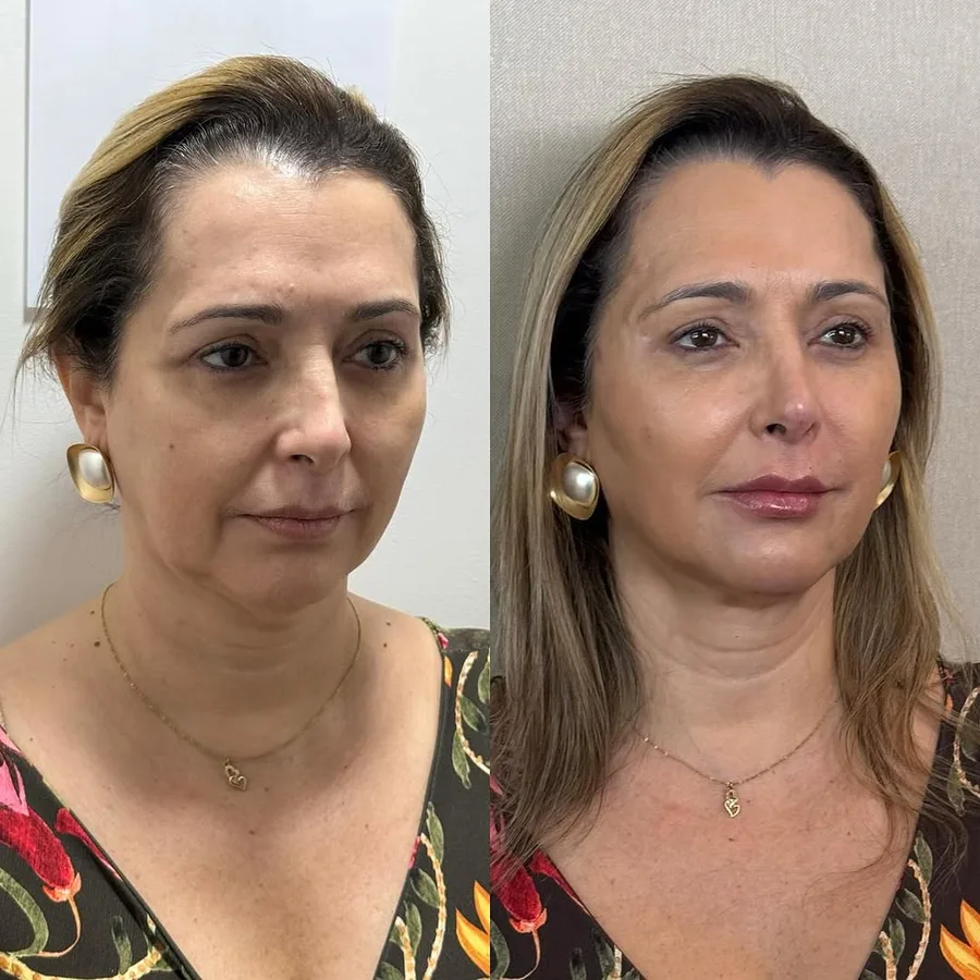 Antes e depois Dra. Bela